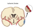 Brain ischemic stroke, eps10