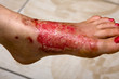 Burn feet