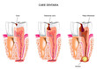 Carie dentaria
