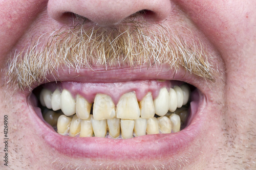 Photo: Yellow teeth are sick studio shot Yellow teeth are sick studio shot