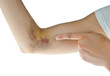 hematoma
