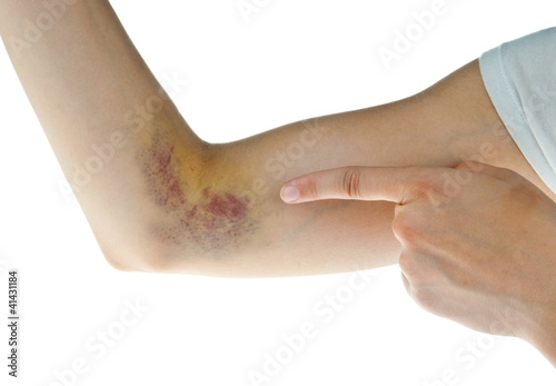 Photo: hematoma hematoma