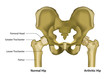 arthritic hip joint medical vector illustration