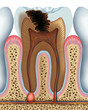 Tooth caries