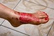 Photo: Burn feet Burn feet