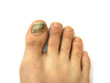 Bruises on toe nails
