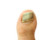 Bruise on toe nail