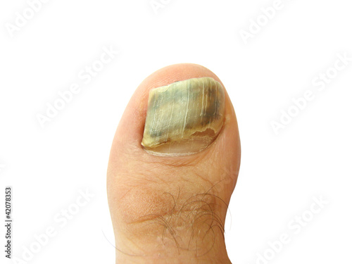 Photo: Bruise on toe nail Bruise on toe nail