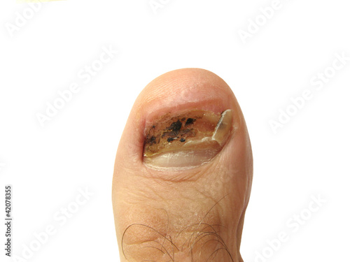Photo: Toe without nail Toe without nail