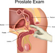 Prostate Exam
