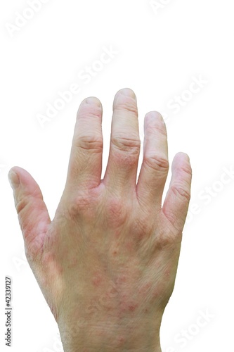 Photo: eczema eczema
