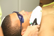 laser depilation of beard hair