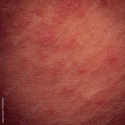 Photo: eczema atopic dermatitis symptom skin texture eczema atopic dermatitis symptom skin texture