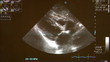Video: ultrasound scan of childs heart ultrasound scan of childs heart