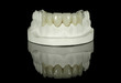 Crown Bridge on Dental Model