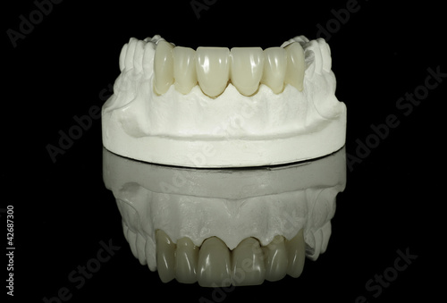 Photo: Crown Bridge on Dental Model Crown Bridge on Dental Model