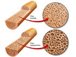 osteoporosi 2
