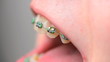 Vídeo : teeth with braces teeth with braces