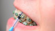 Vídeo : teeth cleaning with braces teeth cleaning with braces