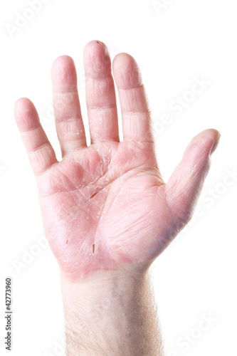 Photo: male palm with eczema isolated on white background male palm with eczema isolated on white background