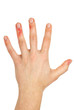 Palm with injured fingers