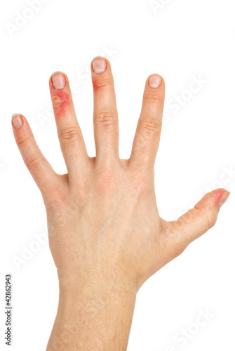 Photo: Palm with injured fingers Palm with injured fingers