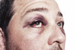 black eye injury accident violence isolated