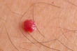 senile angioma