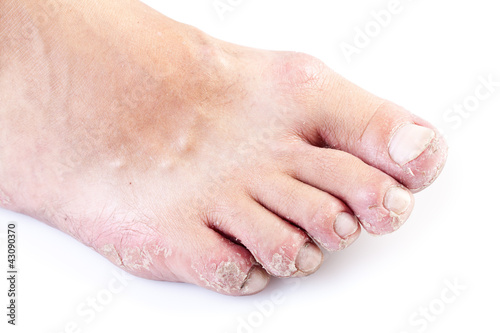 Photo: single male foot with eczema isolated on white background single male foot with eczema isolated on white background