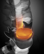 Disc herniation in x-ray view