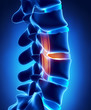 Herniated disc with pressure on spinal cord