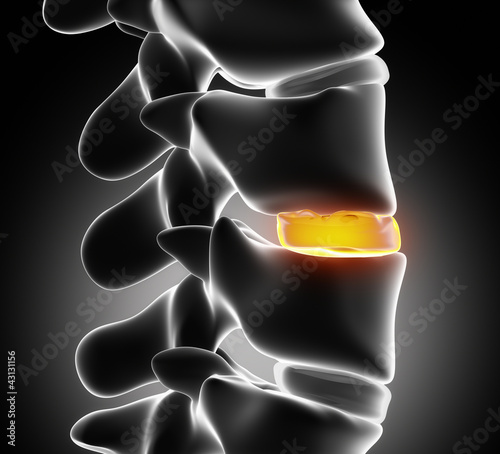 Illustration: Disc degeneration by osteophyte - close up Disc degeneration by osteophyte - close up