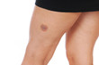 Foto: Blauer Fleck Blauer Fleck
