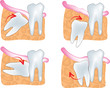 impacted wisdom tooth