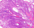 Microscope picture of intestinal polyp