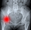 X-ray of pelvis.