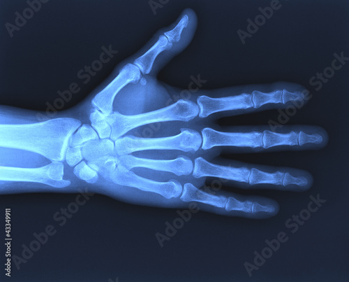 Photo: X-ray hand X-ray hand