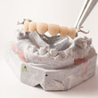 Photo: Metal Ceramic Bridge Metal Ceramic Bridge
