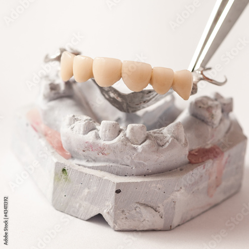 Photo: Metal Ceramic Bridge Metal Ceramic Bridge