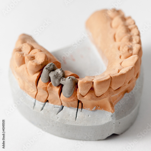 Photo: Metal ceramic bridge structure Metal ceramic bridge structure