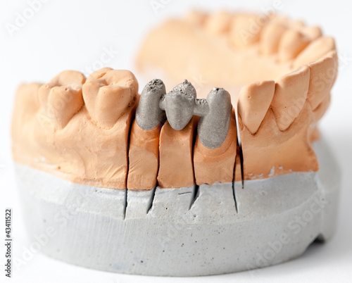 Foto: Metal ceramic bridge structure Metal ceramic bridge structure