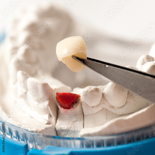 Foto: Zirconia Crown Incisor Zirconia Crown Incisor