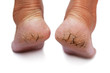 chapped heel