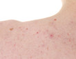 acne on the shoulders of a teenager