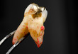 molar with big rotten hole and gold inlay