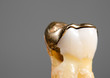 non fitting gold inlay and therefore decay, hole