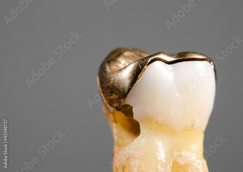 Photo: non fitting gold inlay and therefore decay, hole non fitting gold inlay and therefore decay, hole