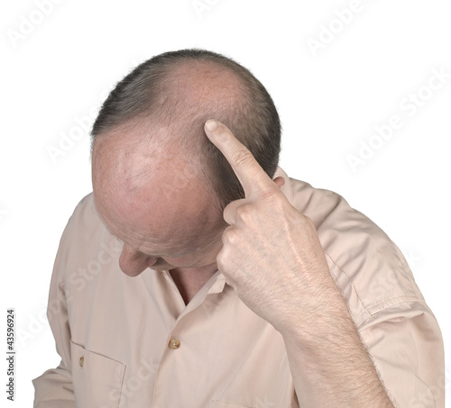 Foto: Human hair loss - adult man hand pointing his bald head Human hair loss - adult man hand pointing his bald head