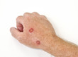 Skin cryotherapy