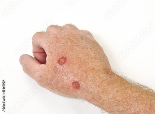 Photo: Skin cryotherapy Skin cryotherapy